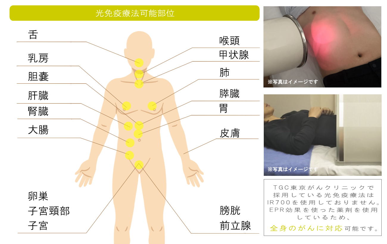 光免疫療法(千葉の方へご紹介)2