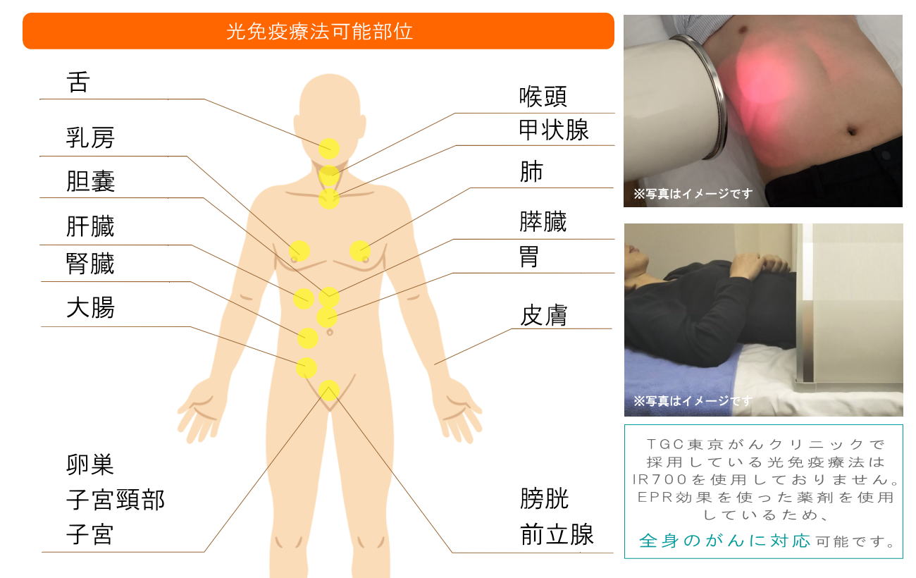 光免疫療法(静岡の方へご紹介)2