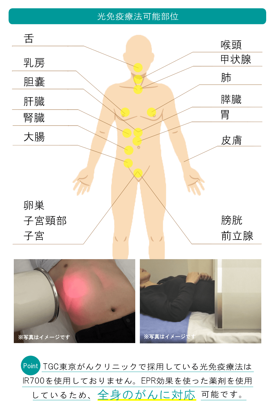 TGCの光免疫療法は全身に対応