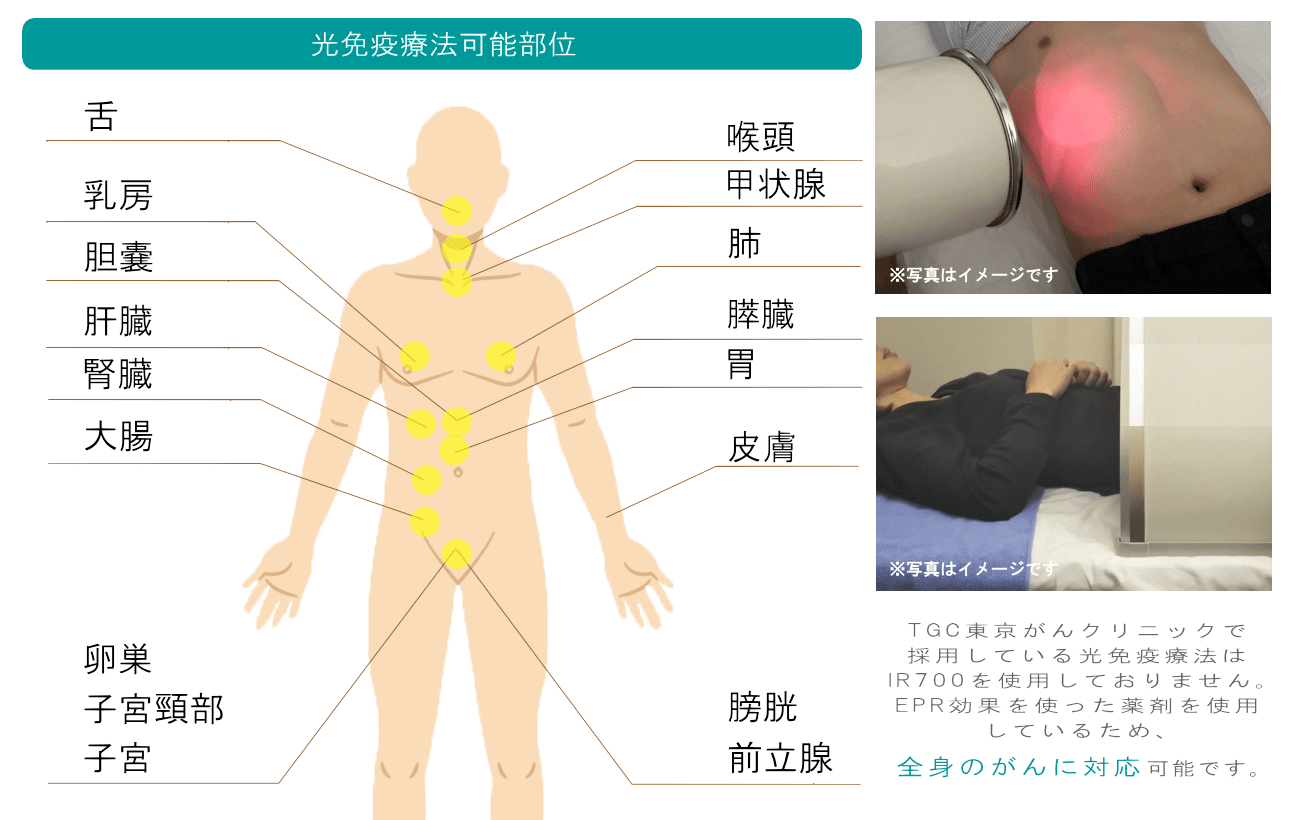 TGCの光免疫療法は全身に対応