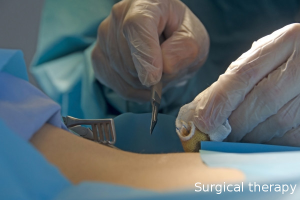 外科療法(手術)